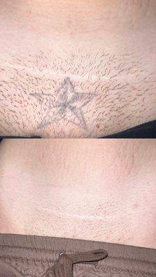 Allure laser Tattoo Removal