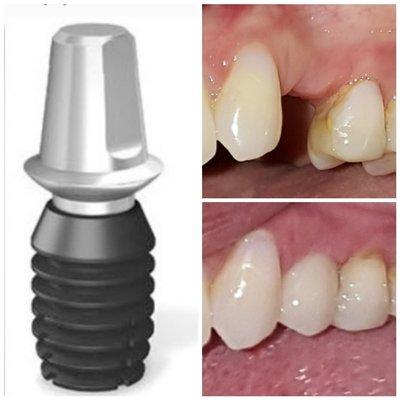 Concept of implant tooth, upper left premolar implant tooth (12)