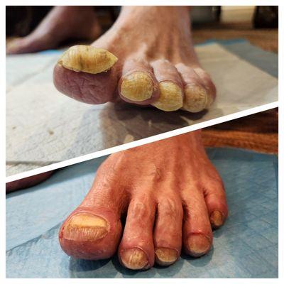 Caring for feet and nails is our passion, let us help you! (permission given by patient to share).