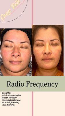 RF treatment for face contouring and skin tightening