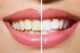 Before and After Smile Labs Teeth Whitening