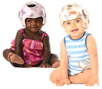 Cranial remolding orthosis is used to treat infants between 3 and 12 months of age for asymmetrical head shapes.