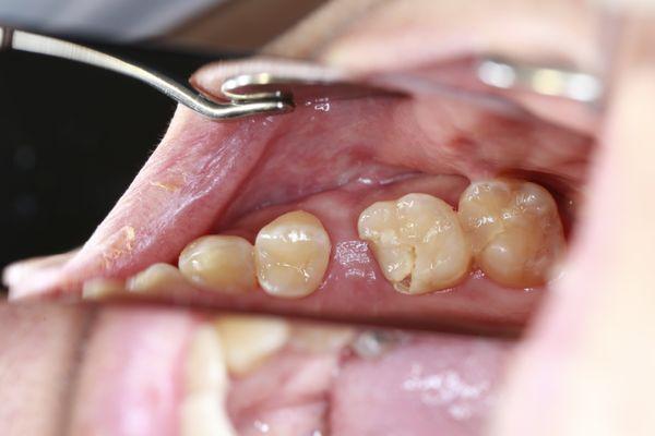 Second tooth to the right has a fracture, Dentist spent less than 10 min filling this cavity. 2 other dentists said this was not done right