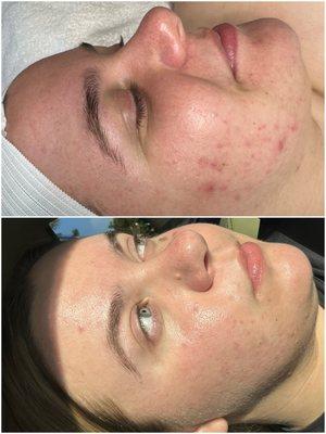 Before and after 3 custom treatments! We targeted post inflammatory hyperpigmentation & scarring