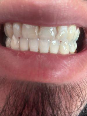 Tooth repaired and barely noticeable