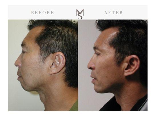 Chin Augmentation Surgery with Chin Implant