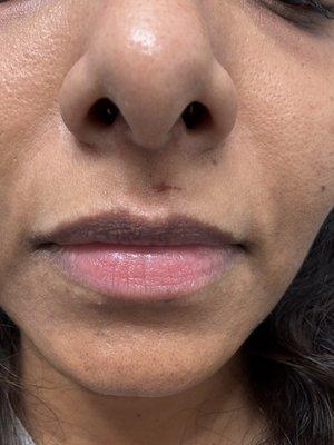 Bruised upper lip and it's 3 days , it is not going away!