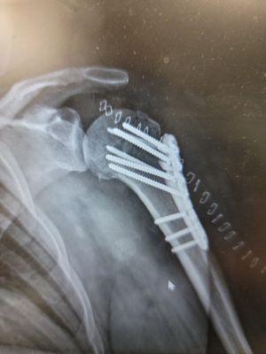 Fixed left humorous immediately post surgery