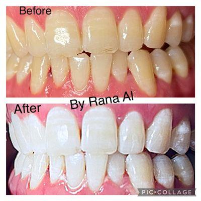 Teeth whitening Before and after!
