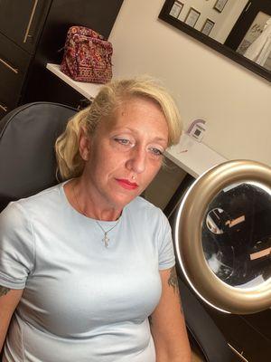 Consultation for Botox