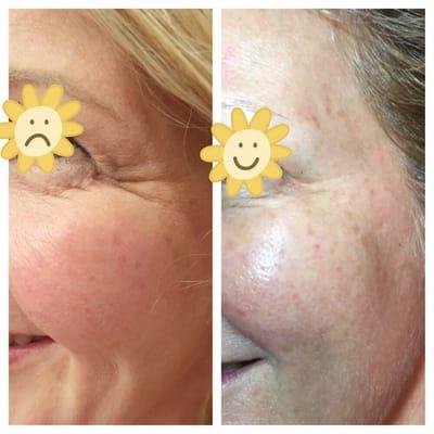 Before & After of Dysport! Visit our Instagram for more pictures! @LumiereRN