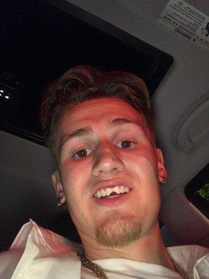 Joe's "before" photo.  Chipped teeth after a back flip at the prom on Saturday.