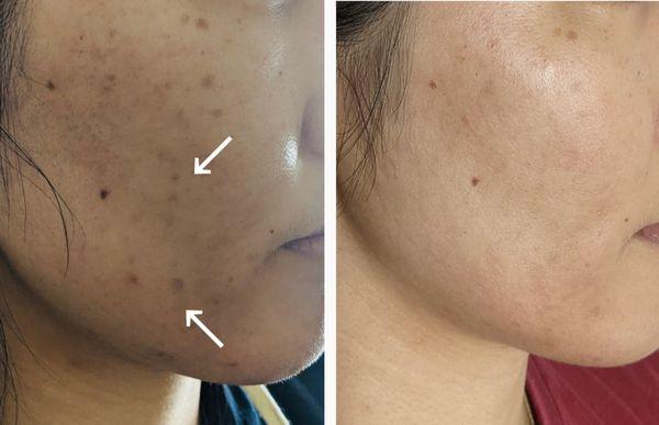 Before/ After 3 Microneedling Sessions