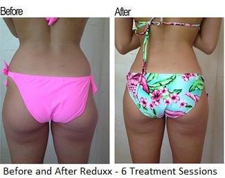 Body Treatment - Before and After Reduxx