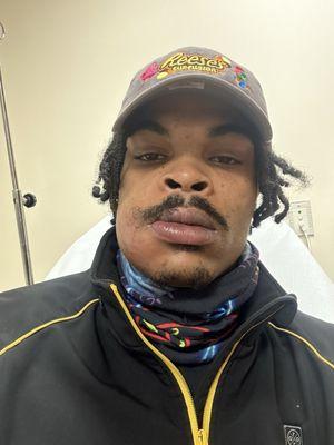 Tooth infection missed by Dr.Carr.