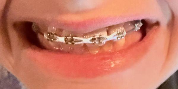 Metal braces on younger daughter