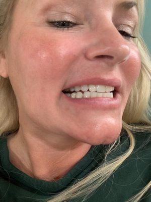 Dental implant crown