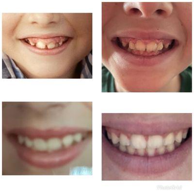 Top two pictures my son (phase 1) Bottom two pictures my daughter (one phase only)