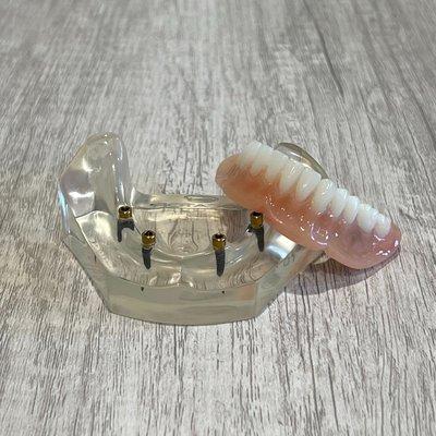 Snap-In implants involve placing 2-4 dental implants, allowing your dentures to securely snap in and out. Also called "Snap-On Dentures".