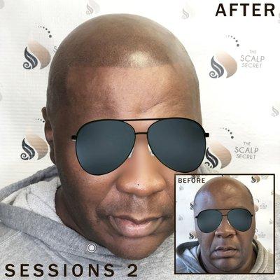 Scalp Micropigmentation Las Vegas. Get yours hairline back, I can help