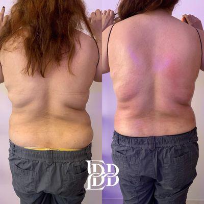 Back fat reduction results after one session