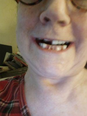 Dr. Brueggen thinks his work is fine. Cash paid, years of being in the chair - for this.