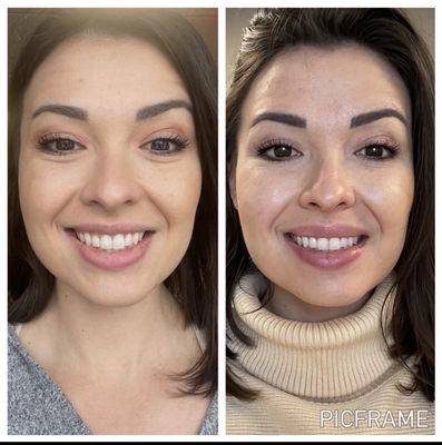 Before (left) treatment and a few days after treatment (right).