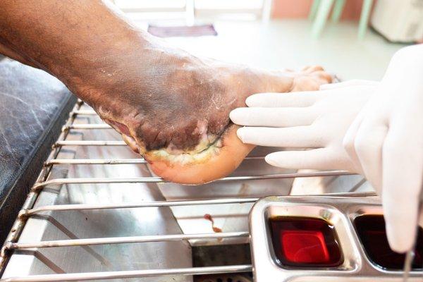 Non-healing wound care specialist