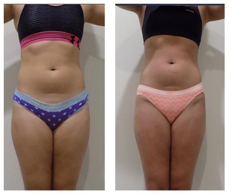 Patient lost 20 inches in 8 treatments