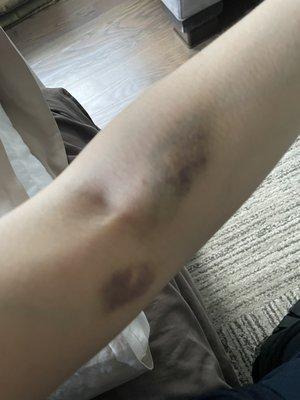 Bruises post blood draw.
