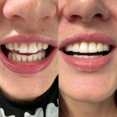 My smile before and after