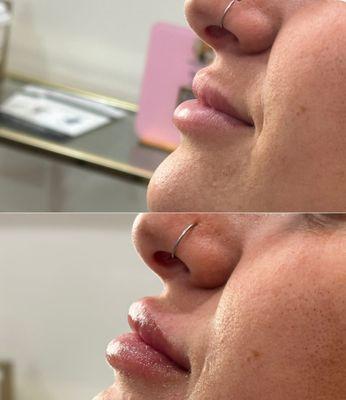 Slidell's go-to med spa for natural lip filler results Enhance your lips, keep your look authentically you.