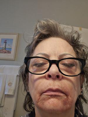 Burnt face from waxing.