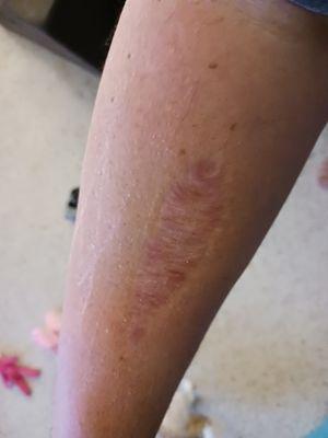 My scar