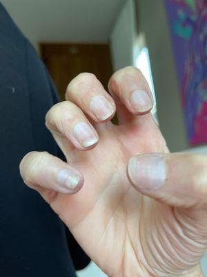 Nails totally destroyed and hanging on for dear life as they lift from the nail bed.