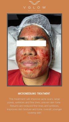 Microneedling with Stem Cell or PRP