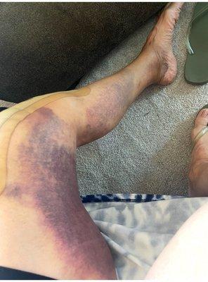 Precision Orthopedics and Sports Medicine