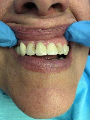 Before placing composite fillings