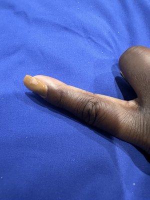 Chipped and cracked polish on index finger