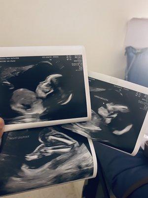 PRENATAL DIAGNOSIS OF NORTHERN CALIFORNIA