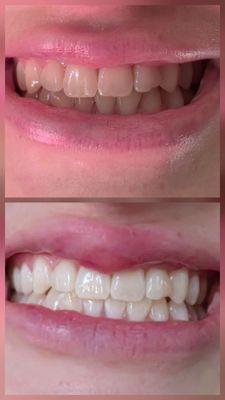 Before and after photos of the Zoom teeth whitening procedure.