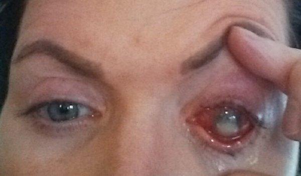 Fungal infection from ptosis repair???