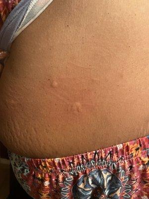 More bed bug bites.