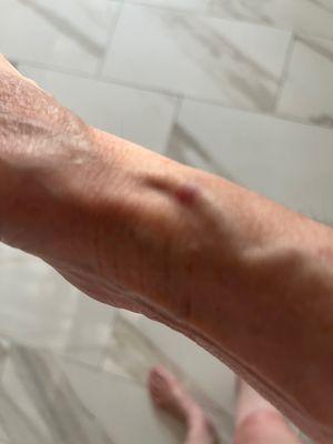 Hand with 1 needle that made vein in my wrist blow up and is very painful.