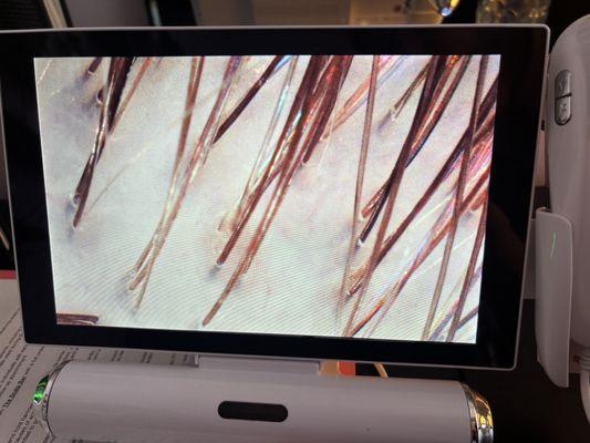 After of a squeaky clean scalp, far less irritated, and far less buildup