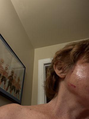 Have to zoom in since it's dark. Right side bloody rip to my skin I found at home.