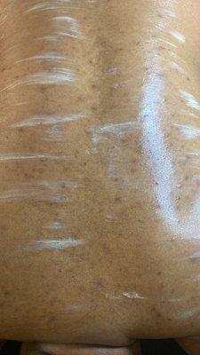 Back Treatment (massage) 10min mask. Using Dermalogica AgeSmart.