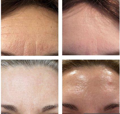 Neurotoxin (Botox, Jeuveau, Xeomin, Daxxify) helps in smoothing off the static wrinkles which are usually visible in relaxed face muslces