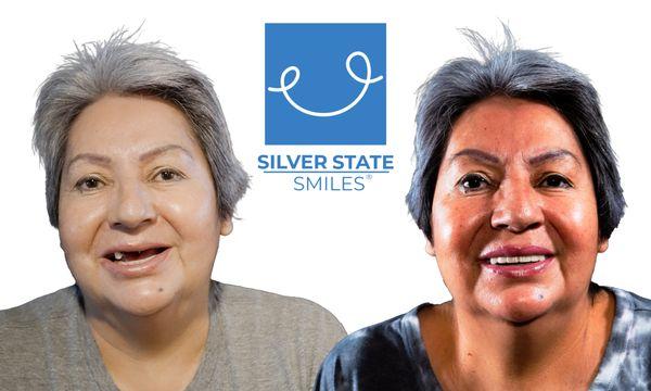 Get a Forever Smile! Full, permanent transformation using modern Dental Implants at Silver State Smiles, Las Vegas.