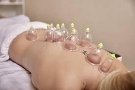 Cupping Therapy